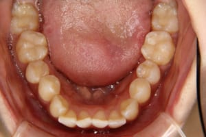 歯列の幅が狭く前歯が出ています